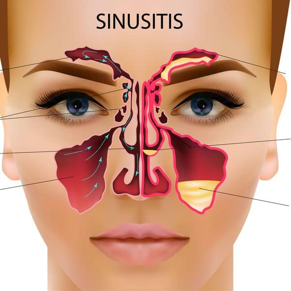 Sinusitis, De EetLijn